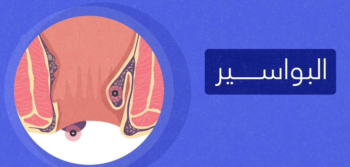 معالجة البواسير بالمنزل