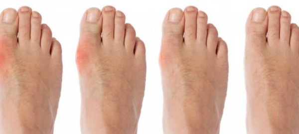 تشخيص مرض النقرس أسبابه وعلاجه