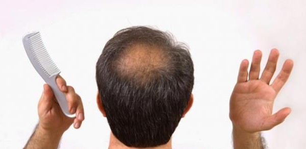 تشخيص تساقط الشعر الأسباب والعلاج