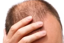 تشخيص تساقط الشعر الأسباب والعلاج