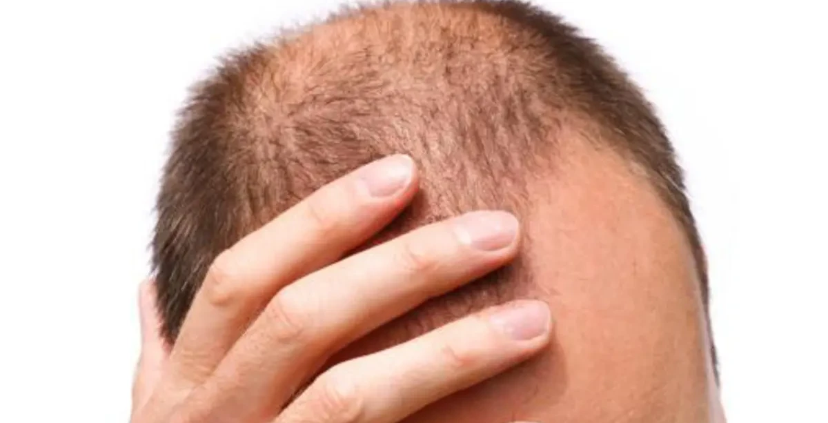 تشخيص تساقط الشعر الأسباب والعلاج