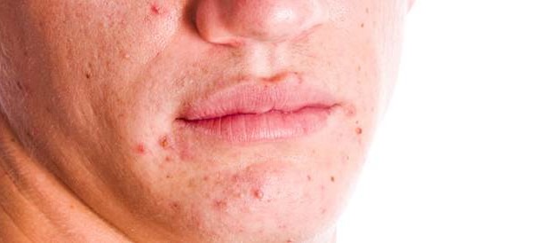 علاج حب الشباب وطرق الوقاية وأسباب ظهورة 