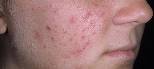 علاج حب الشباب وطرق الوقاية وأسباب ظهورة 