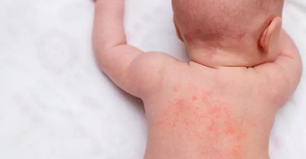 علاج حمو النيل وطرق الوقاية للأطفال والشباب