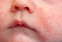 علاج حمو النيل وطرق الوقاية للأطفال والشباب