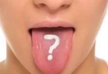 مرارة الفم