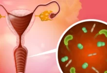 مواجهة فطريات المهبل والعلاجات المستخدمة طبياً