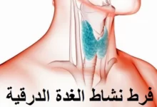 فرط نشاط الغده الدرقية