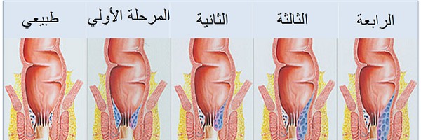 انواع البواسير والعوامل المسببة والعلاجات الدوائية والجراحية 