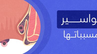انواع البواسير والعوامل المسببة والعلاجات الدوائية والجراحية