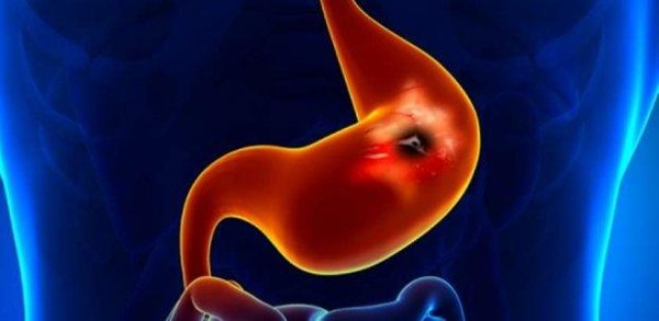 حبوب لعلاج التهاب المعدة وتجنب 5 أسباب للاصابة وطرق العلاج