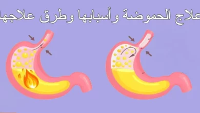 أسباب وعلاج الحموضة في المنزل