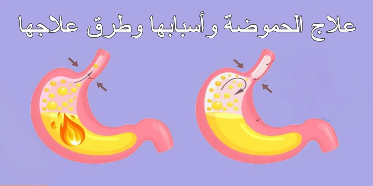 أسباب وعلاج الحموضة في المنزل