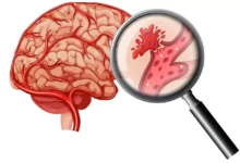 السكتة الدماغية و 14 سبب يصيبك بها 27 السكتة الدماغية