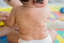 مرض الحصبة الألمانية