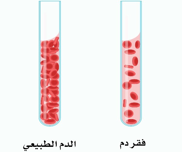 مرض فقر الدم