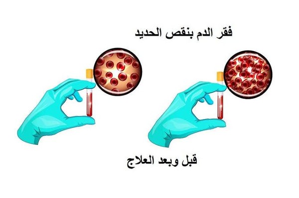 فقر الدم بسبب نقص الحديد