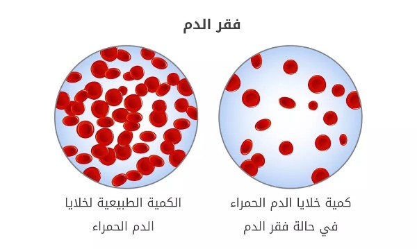 فقر الدم بسبب نقص الحديد