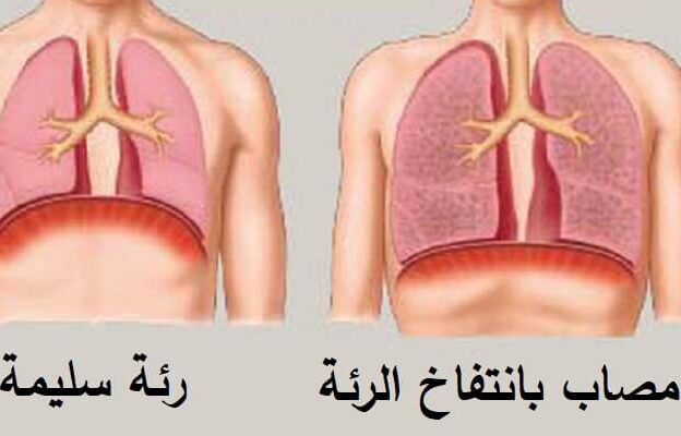 مرض إنتفاخ الرئة