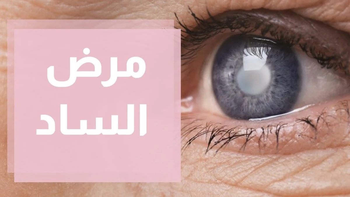 مرض الساد