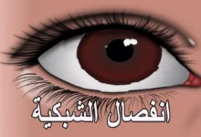 انفصال الشبكية
