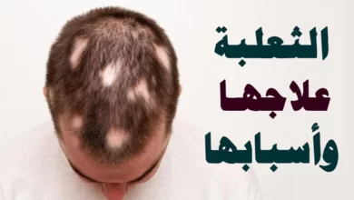 مرض الثعلبة