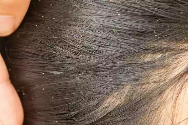 رؤية القمل في المنام