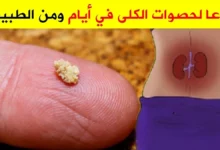أفضل علاج لتفتيت حصى الكلى