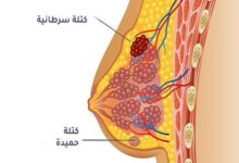 كيف يكون وجع سرطان الثدي