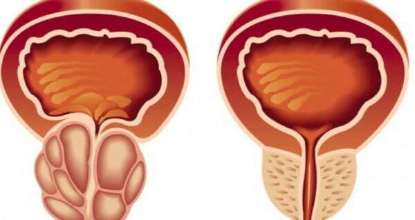 أسباب تضخم البروستاتا في سن مبكر