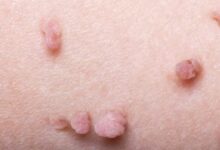 هل الثآليل التناسلية تمنع الزواج ؟ 26 هل الثآليل التناسلية تمنع الزواج