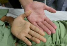 هل فقر الدم يسبب ازرقاق اليدين ؟ 27 هل فقر الدم يسبب ازرقاق اليدين