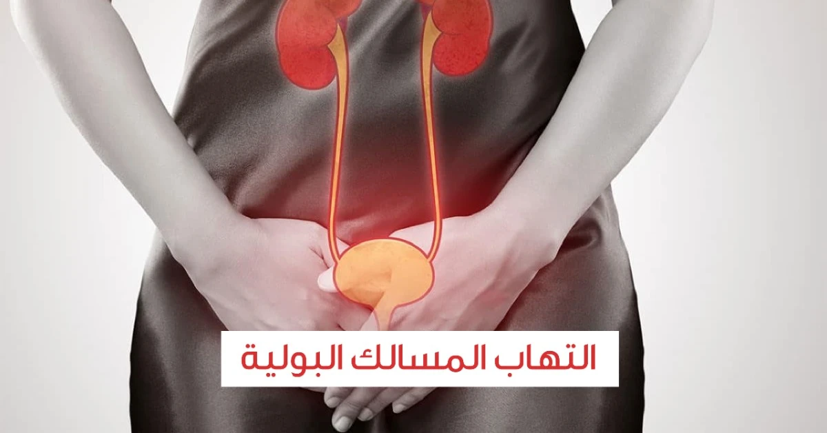 علاج التهاب المسالك البولية