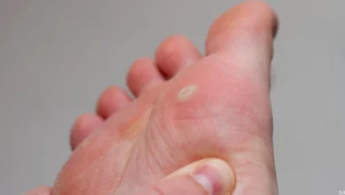 علاج عين السمكة بالرجل