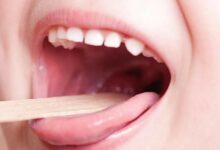 التخلص من التهاب الحلق بسرعة
